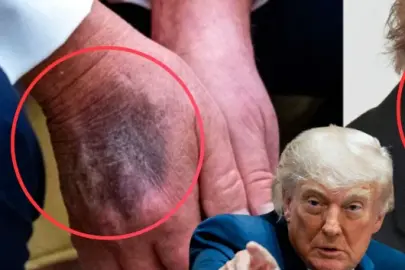 Herkes o morlukları ve lekeleri konuşuyordu: Trump’ın sağlık raporunda şaşırtan '14 yıl' detayı