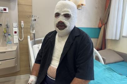 Hararet yapan araca acele müdahale ikinci derece yanığa neden oldu