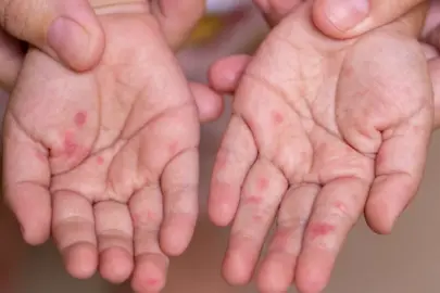 Kızamık alarmı: İngiltere'de iki çocuk hayatını kaybetti