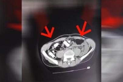 Hepsi mide ve bağırsaklarından çıktı! Tutuklanarak cezaevine gönderildi
